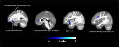 Elevated serum platelet count inhibits the effects of brain functional changes on cognitive function in patients with mild cognitive impairment: A resting-state functional magnetic resonance imaging study